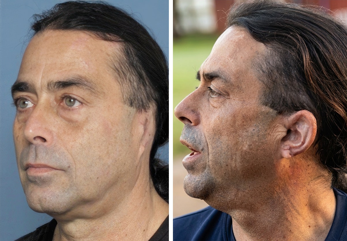 patient before and after ear reconstruction