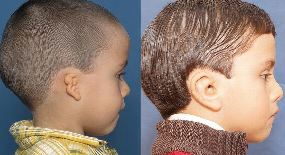 Young boy before and after microtia repair