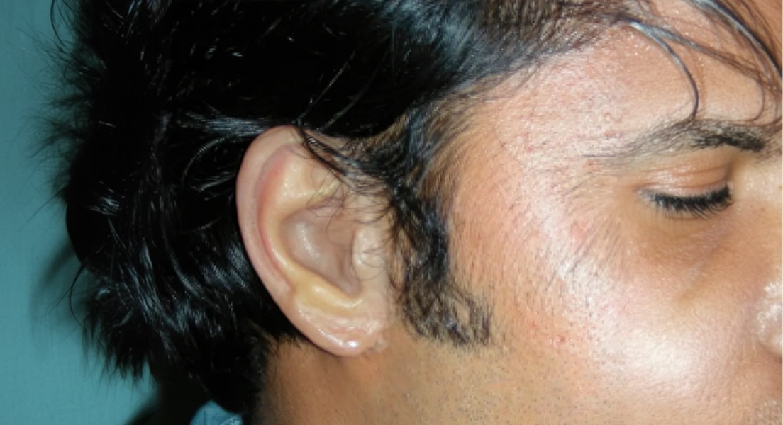 Silicone prosthetic ear