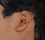 Grade 2 Microtia