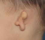Grade 3 Microtia