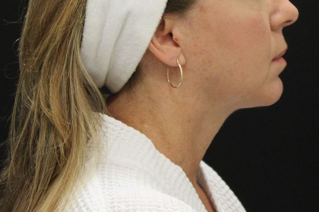 After Neck Lift