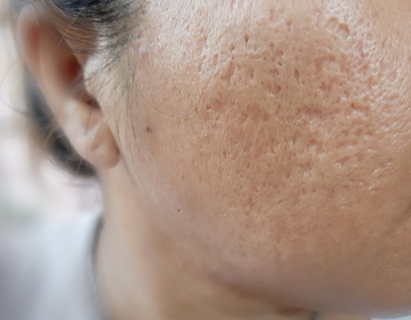 acne scarring