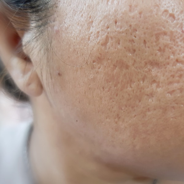 acne scarring