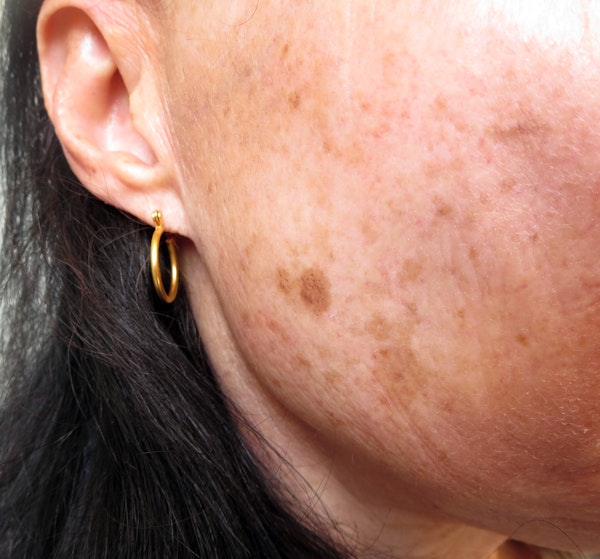 skin discoloration
