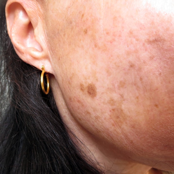skin discoloration
