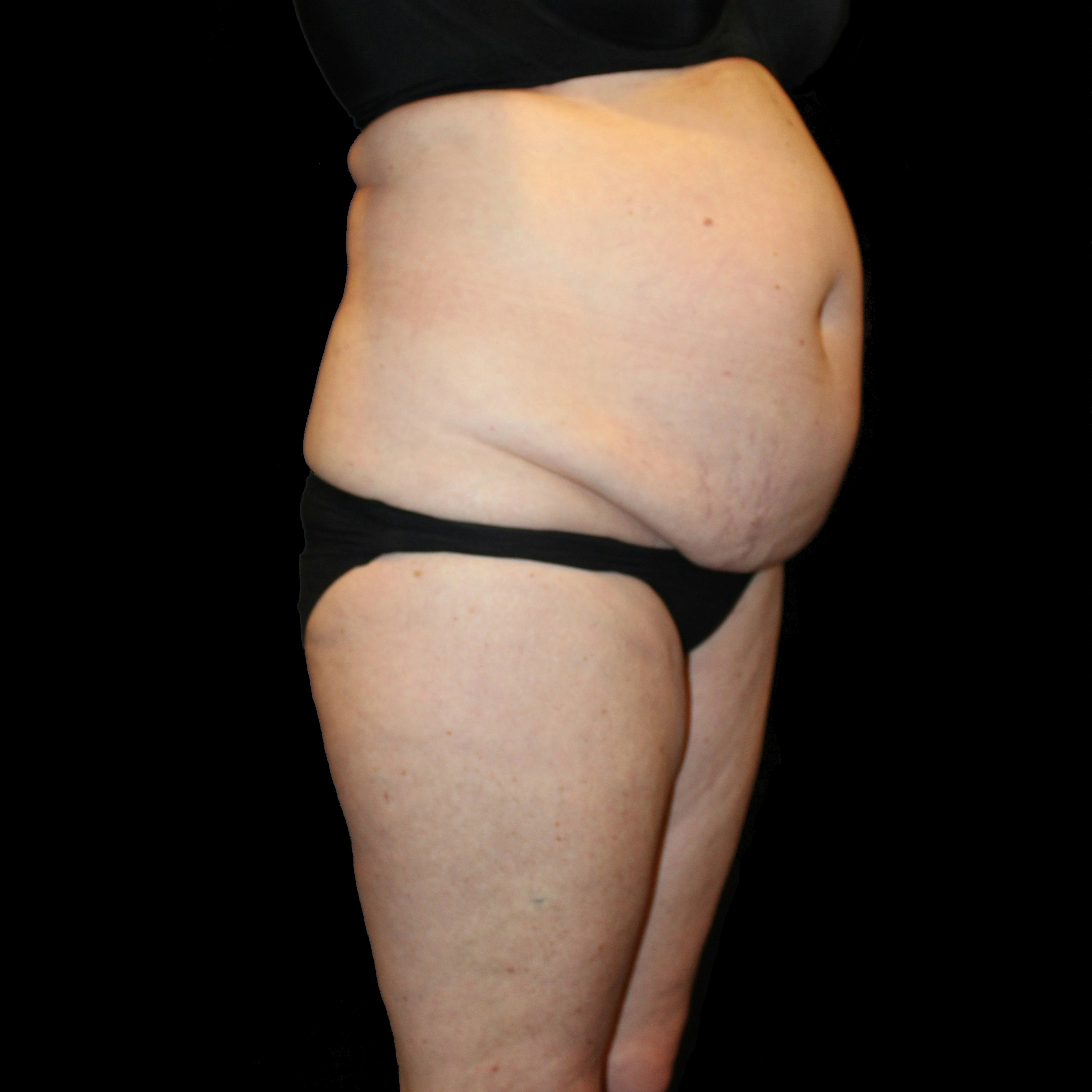before abdominoplasty