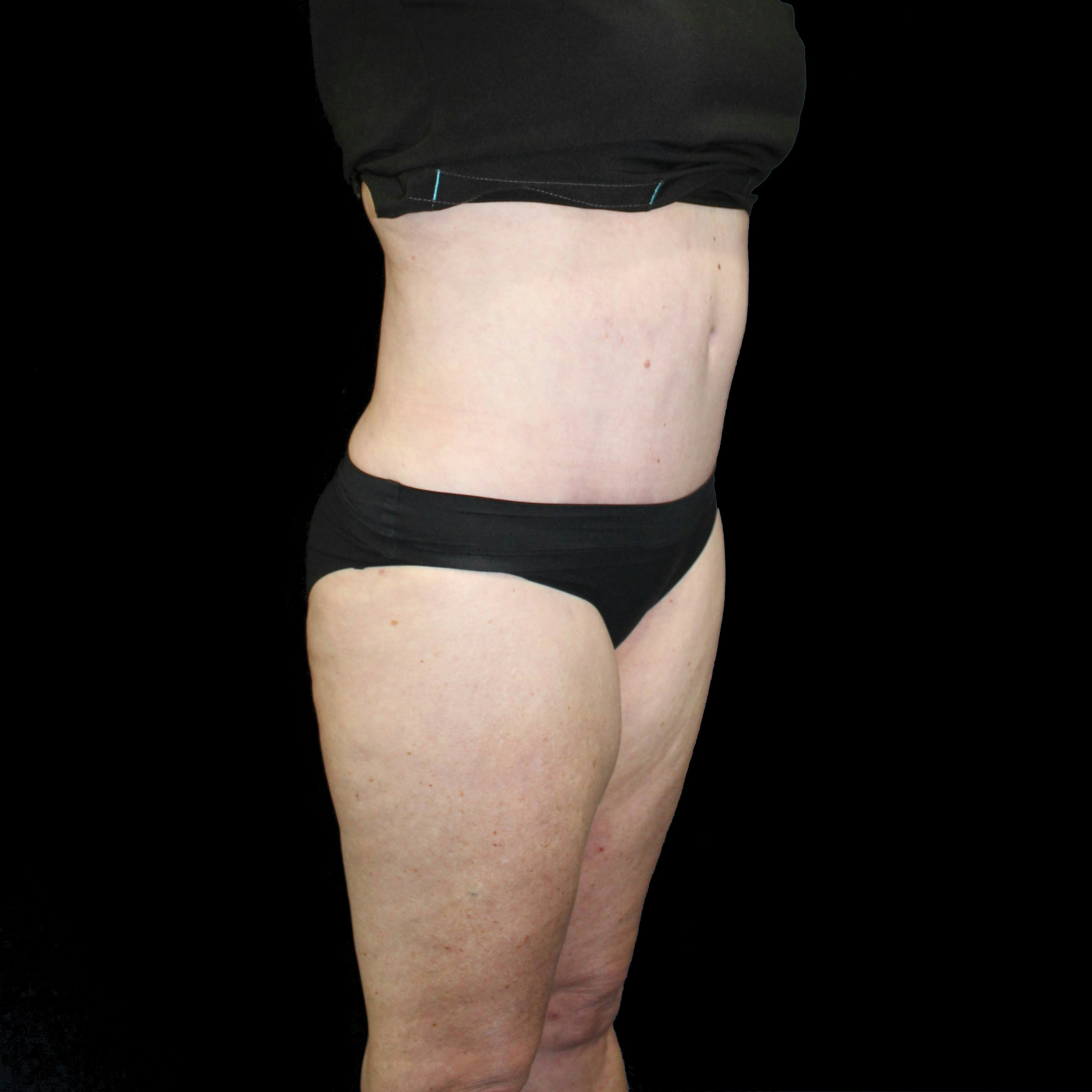 after abdominoplasty
