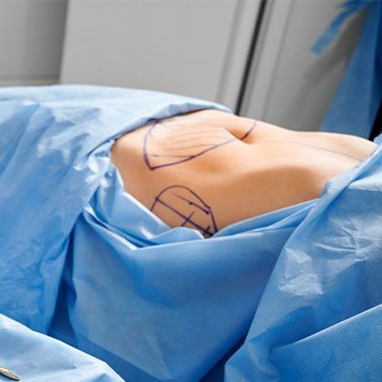 Patient in surgery with marked areas for mommy makeover procedures