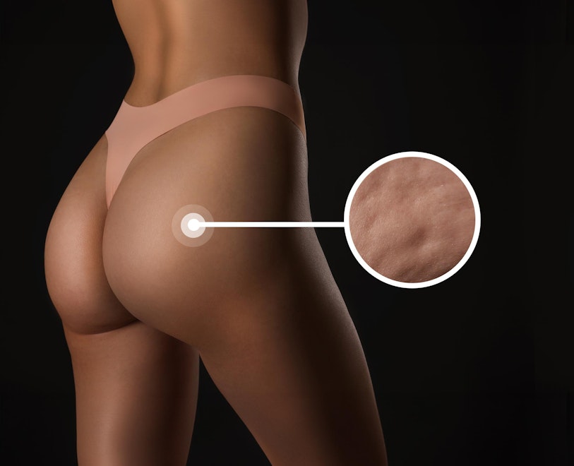 woman's smooth buttocks after cellulite treatment with Aveli