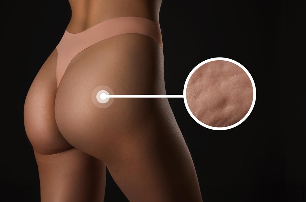 woman's smooth buttocks after cellulite treatment with Aveli