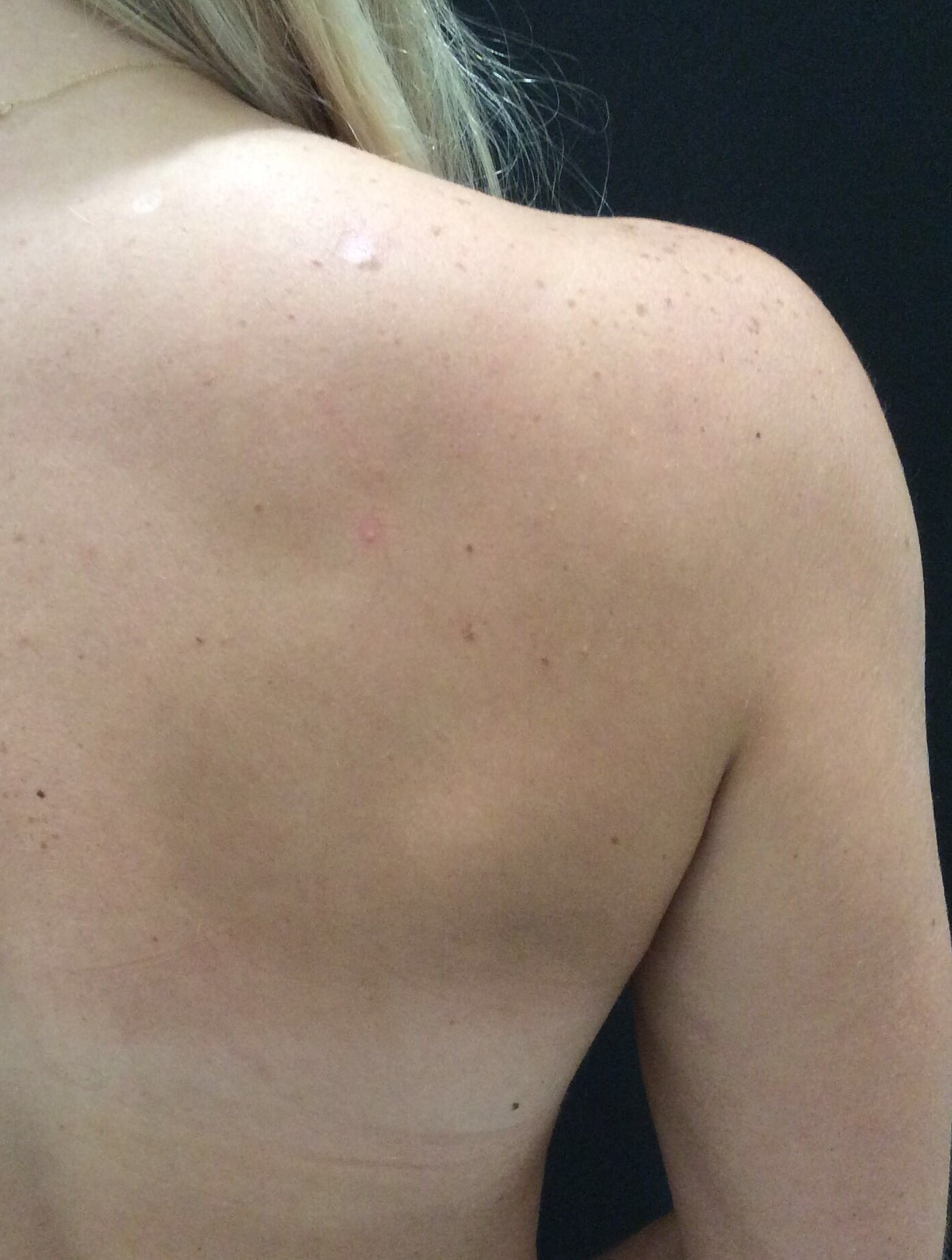 Case 5 before laser tattoo removal