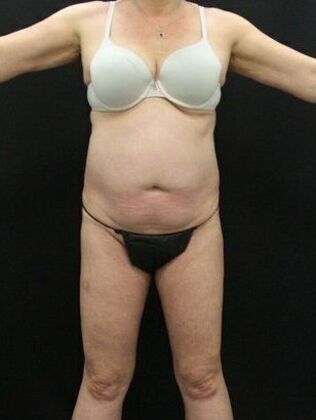before abdominoplasty