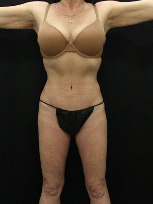 after abdominoplasty
