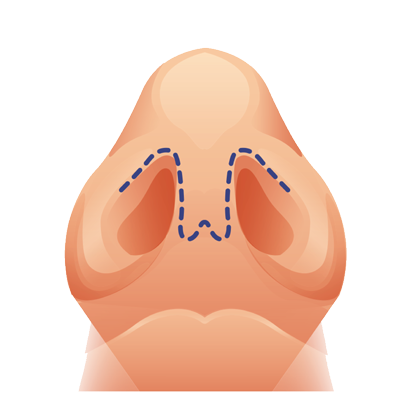 illustration of an open nose job