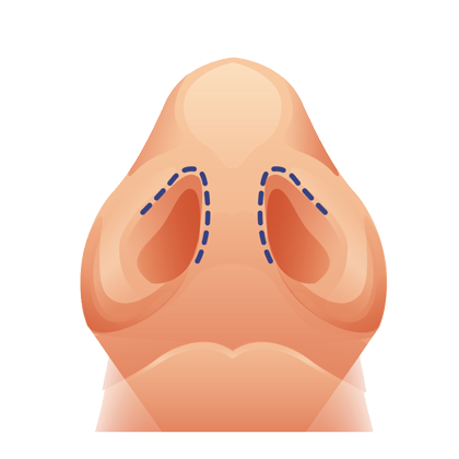 illustration of a closed nose job