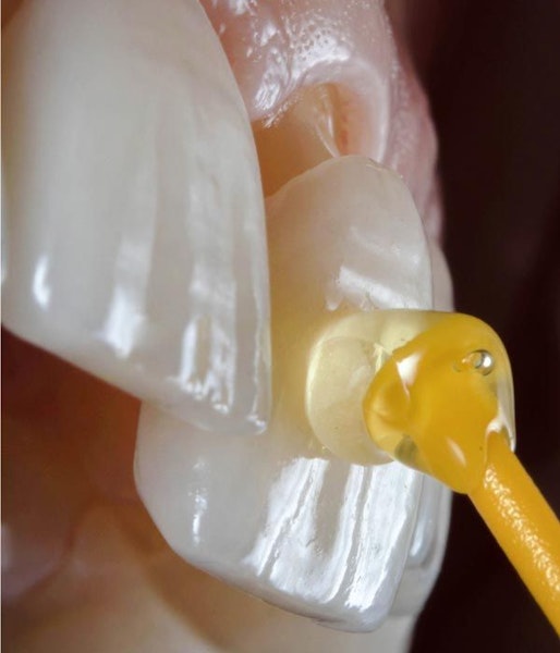 dentist placing a veneer