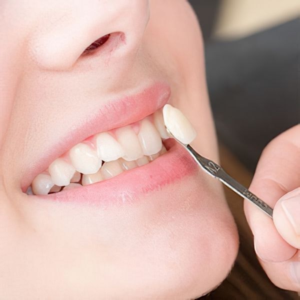 veneer being color-tested against patient's teeth