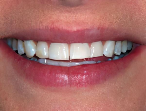 Nordhus Dentistry Patient Before Veneers