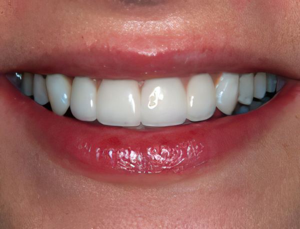 Nordhus Dentistry Patient After Veneers
