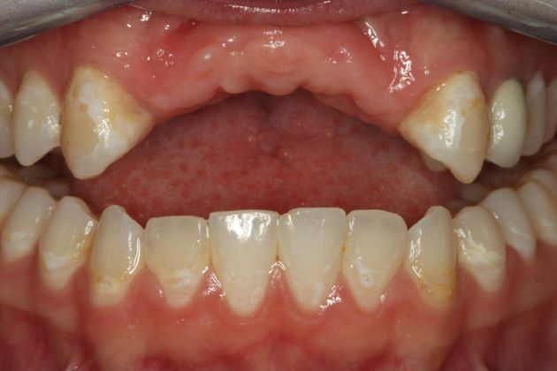 Case 5 before implants