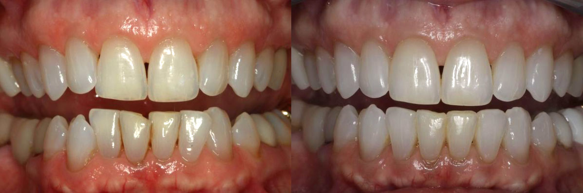 teeth before and after invisalign