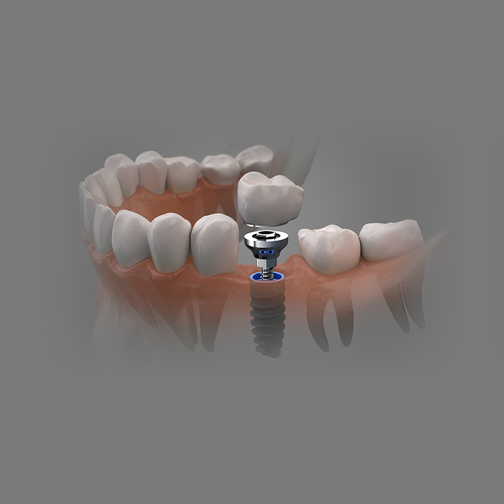 Implant crown