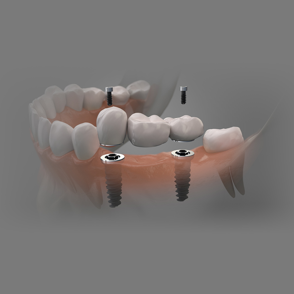 Implant bridge
