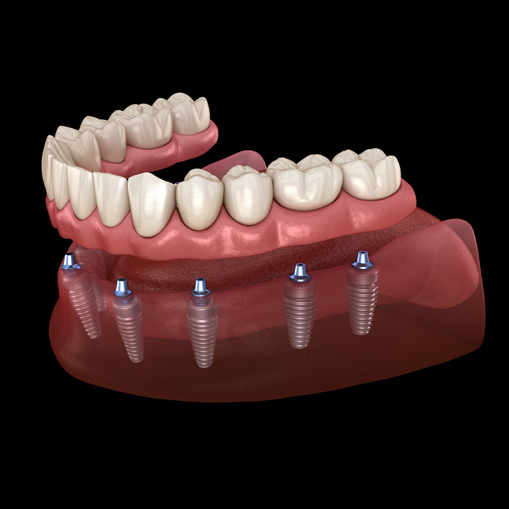 Implant denture