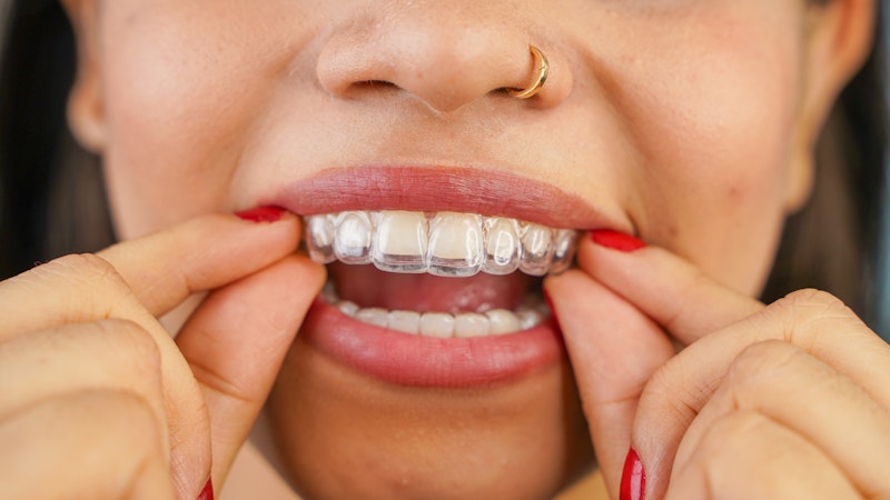 Invisalign Aligners