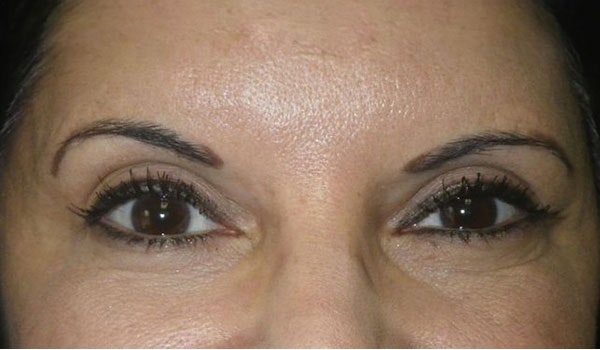 Fewer crow's feet or fine lines after treatment