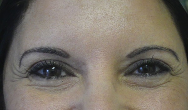 Crow's feet and fine lines before treatment