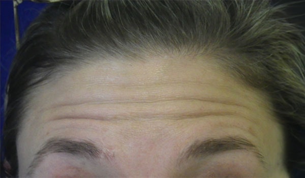Forehead wrinkles before treatment