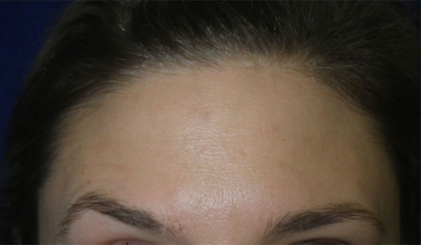 No forehead wrinkles after treatment