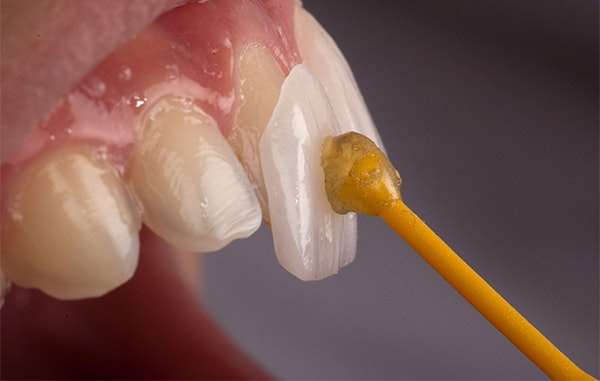 closeup of a veneer being bonded to a front tooth