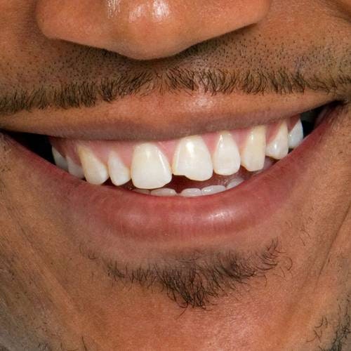 man with chipped front tooth