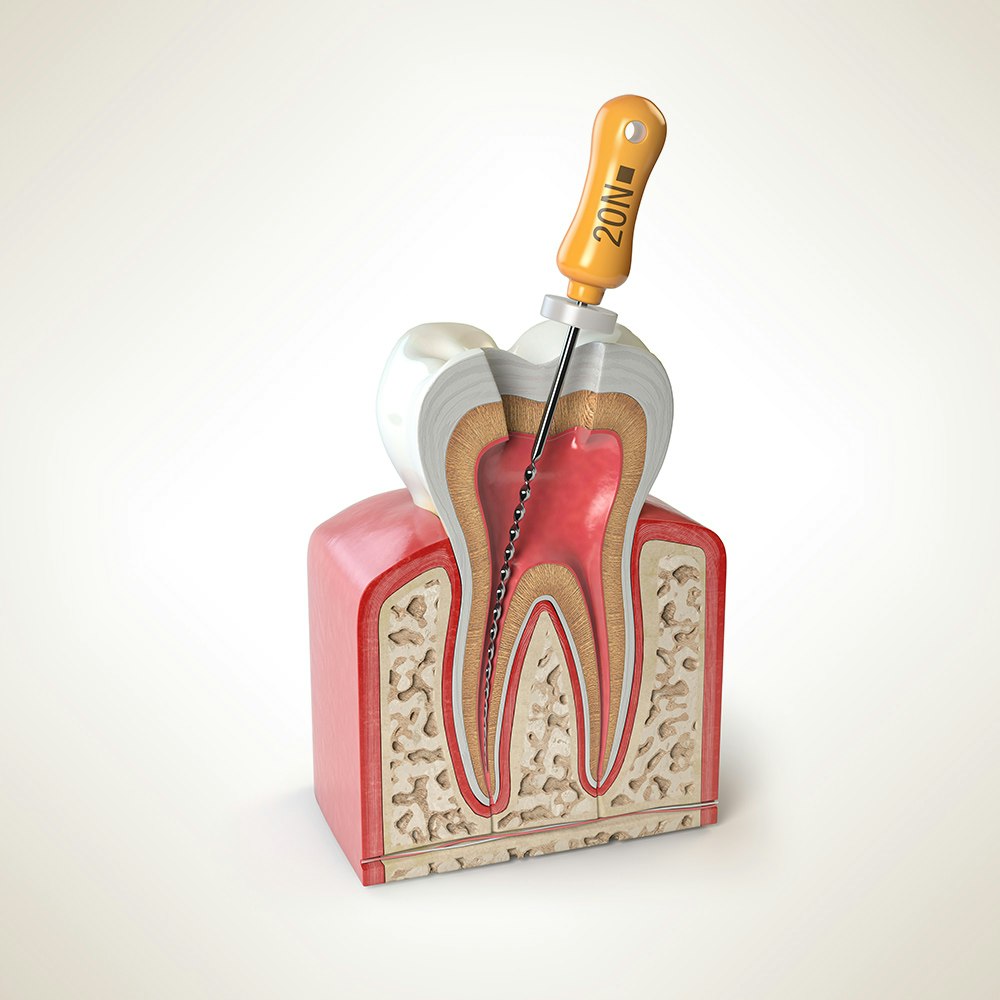 Root canal model