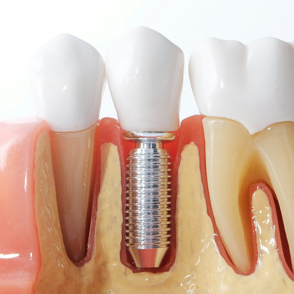 dental implant model