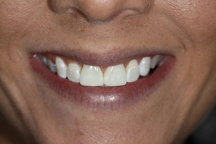 Advanced Dentistry of Blakeney patient before a smile makeover