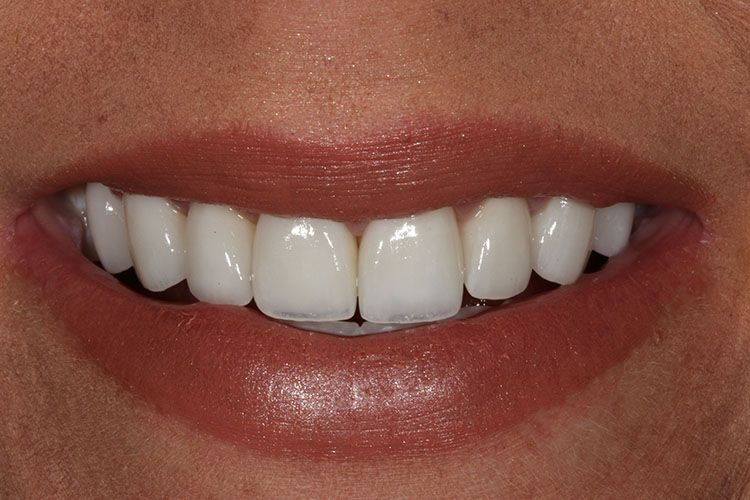 Advanced Dentistry of Blakeney patient after a smile makeover