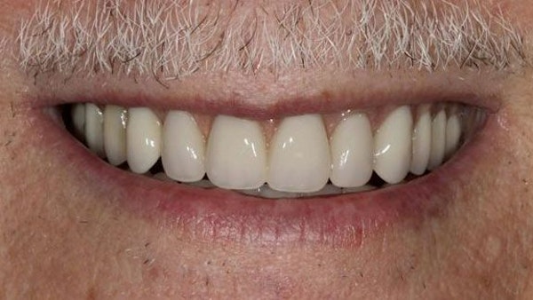 Implant denture