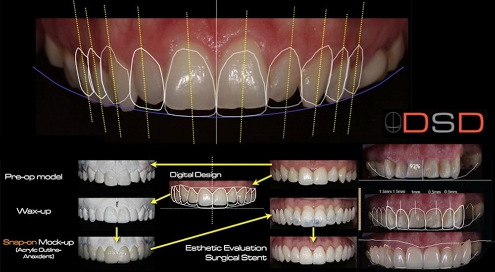 Digital smile design