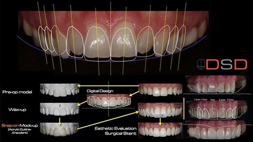 Dental Fillings – Charlotte, NC - Advanced Dentistry of Blakeney