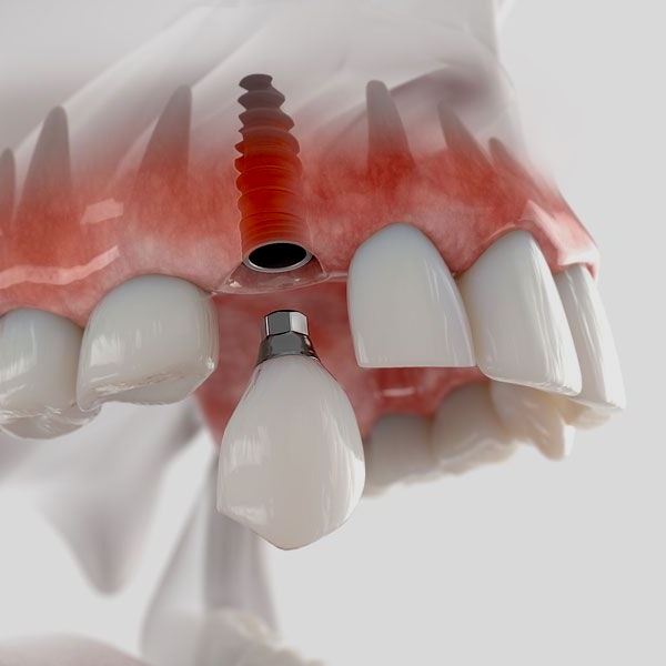 traditional dental implant