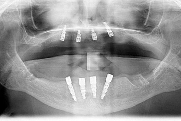 X-rays of implants in jaw