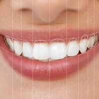 Woman's beautiful smile after smile makeover