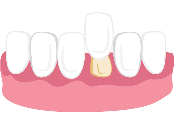 Dental crown placement