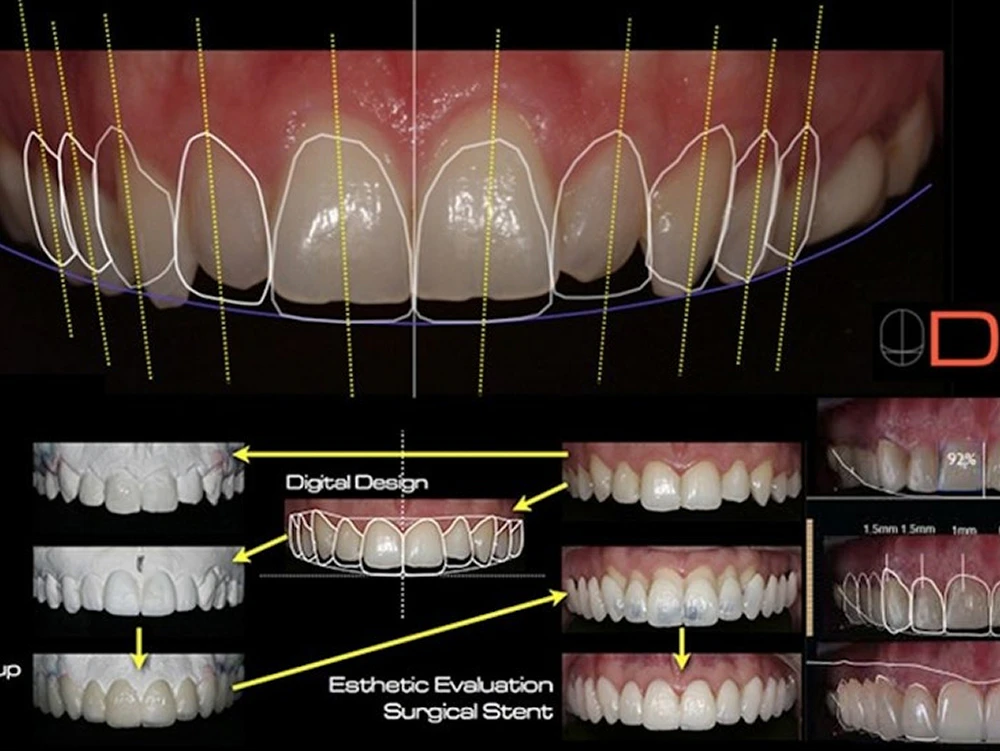 digital smile design