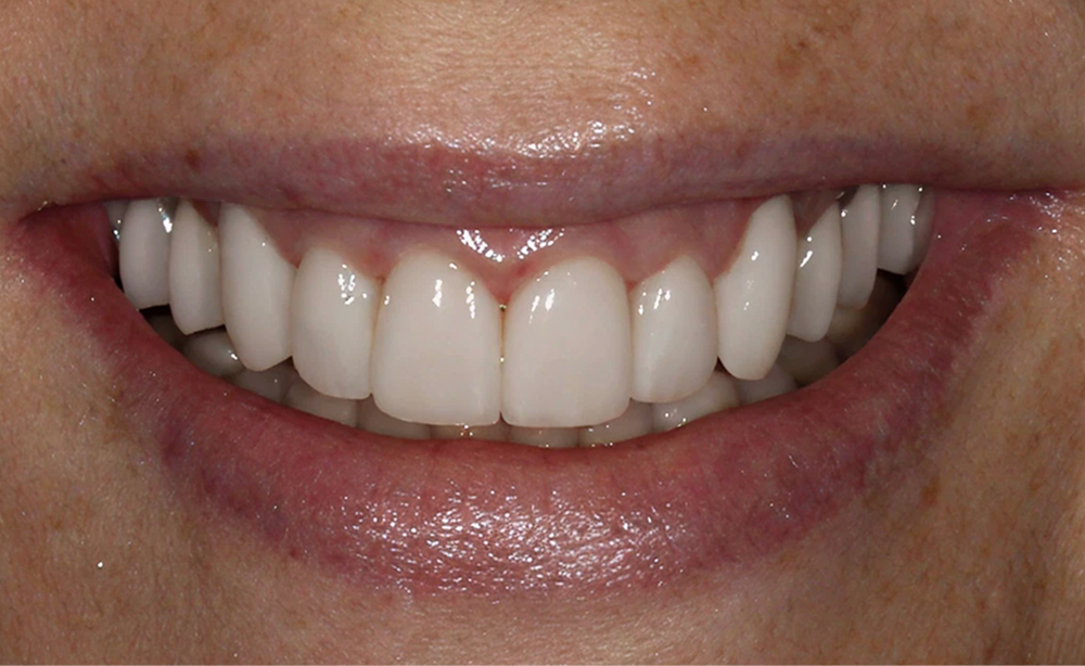 Dr. Pinnix's patient after a smile makeover
