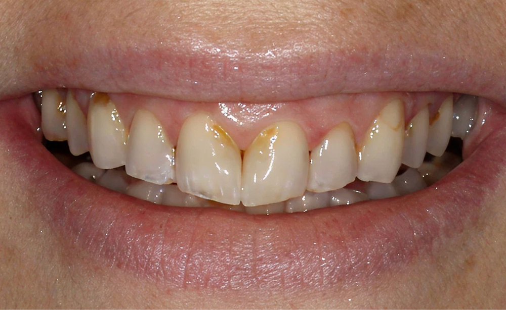 Dr. Pinnix's patient with stained, worn teeth